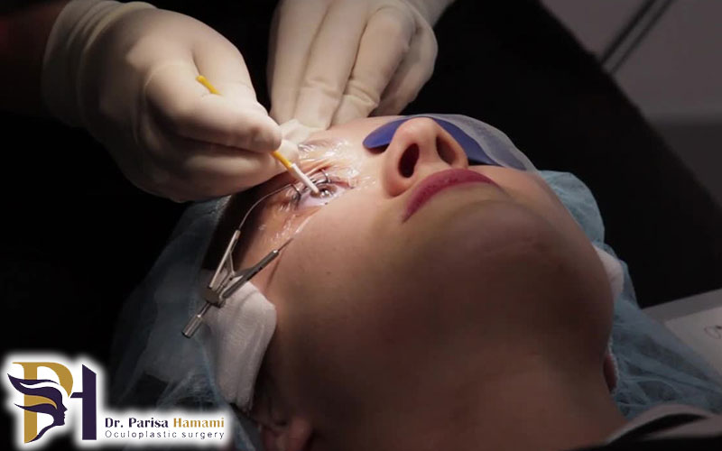 عمل پی آر کی