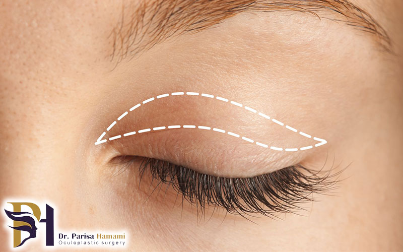 بلفاروپلاستی پلک بالا