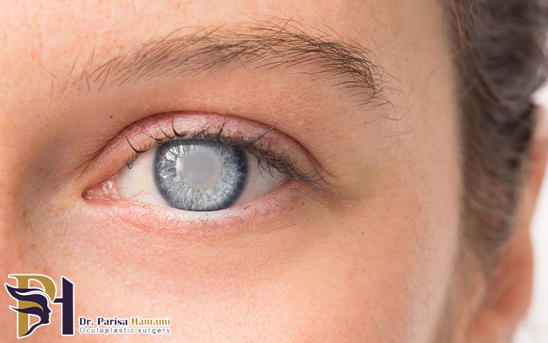 بیماری آب مروارید چیست