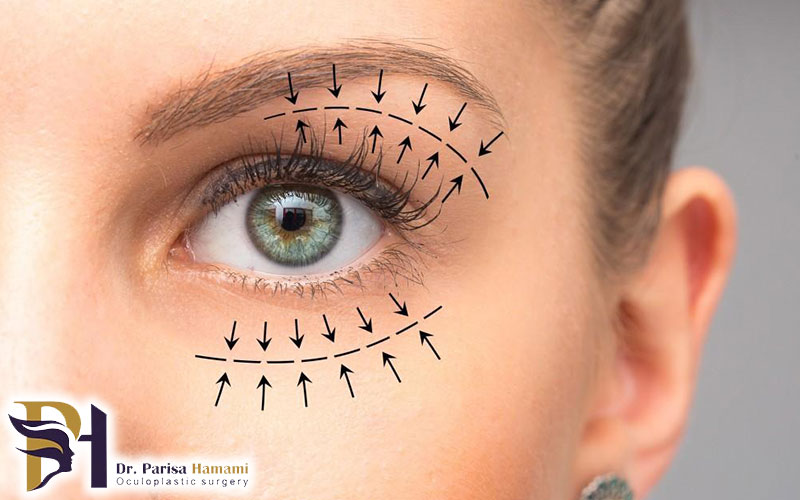 بلفاروپلاستی پلک