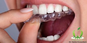ارتودنسی نامرئی در اصفهان