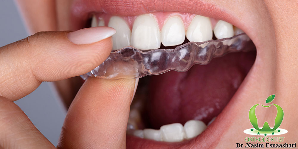 ارتودنسی نامرئی در اصفهان