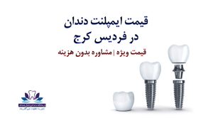 ایمپلنت در کرج