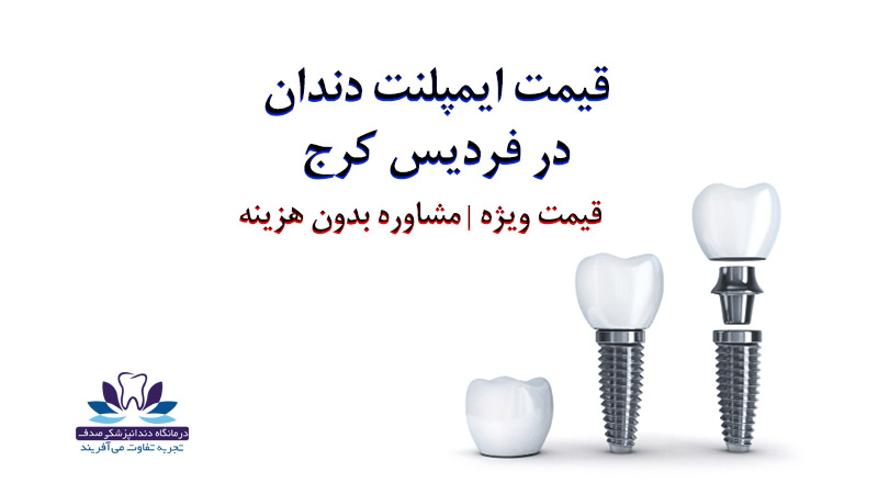 ایمپلنت در کرج